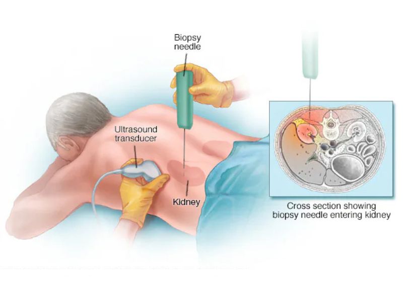 Kidney Biopsy Specialist in Mumbai