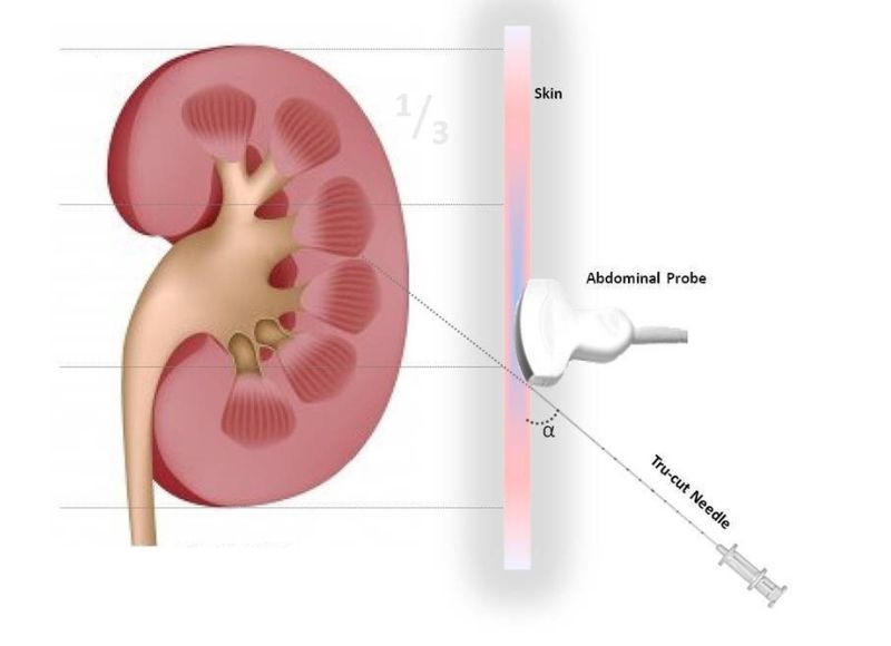 Kidney Biopsy Specialist in Mumbai